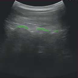 Ultrasound Segmentation