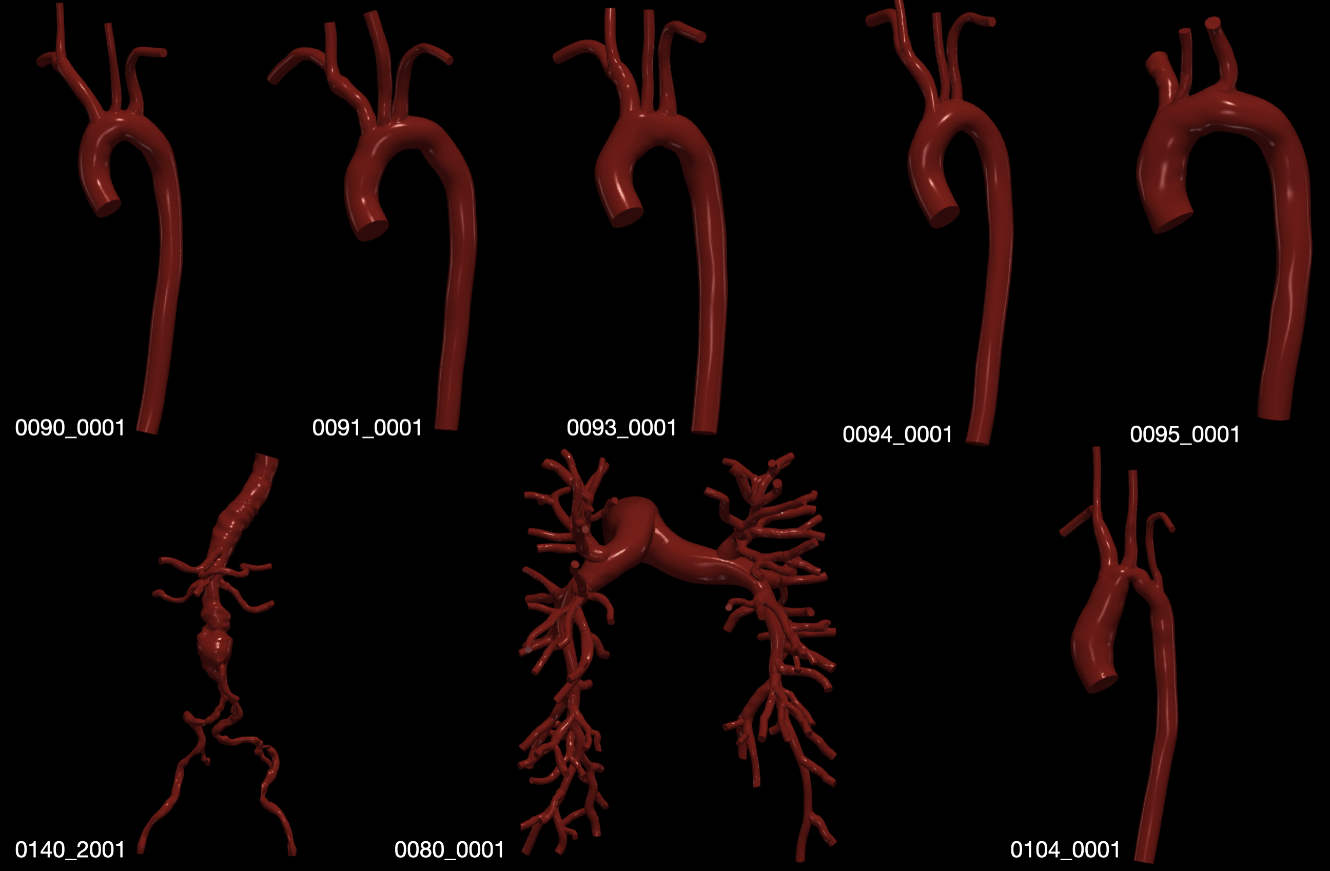 Patient-specific geometries contained in the dataset.